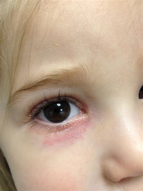 toddler has bags under eyes|bags under babies eyes.